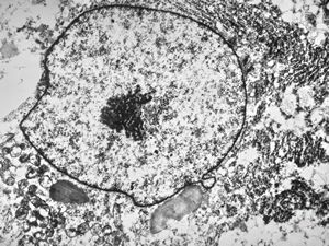 F,39y. | metastatic alveolar sarcoma of soft parts